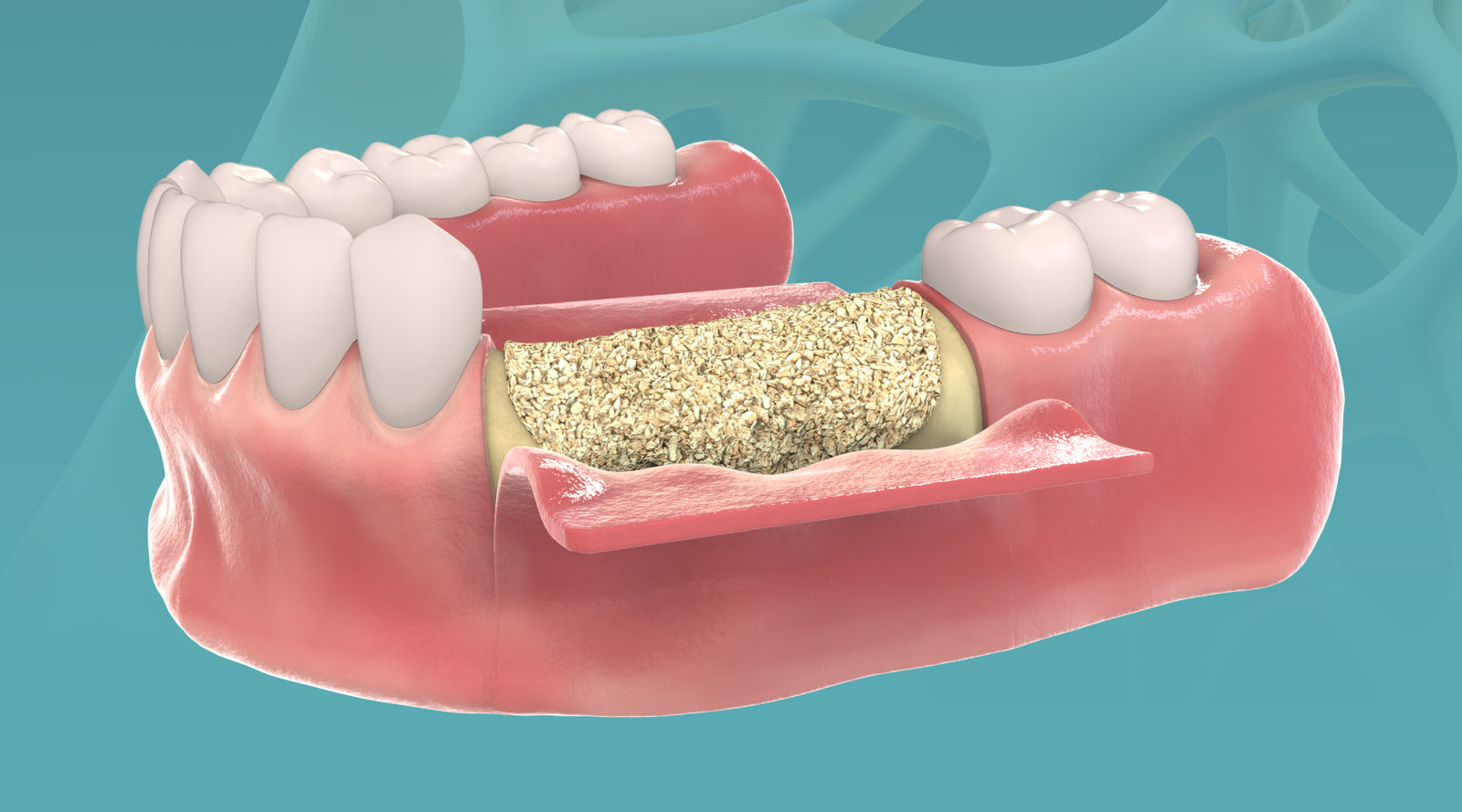 The Advantages of Bovine Bone Graft Granules in Dental Implantology