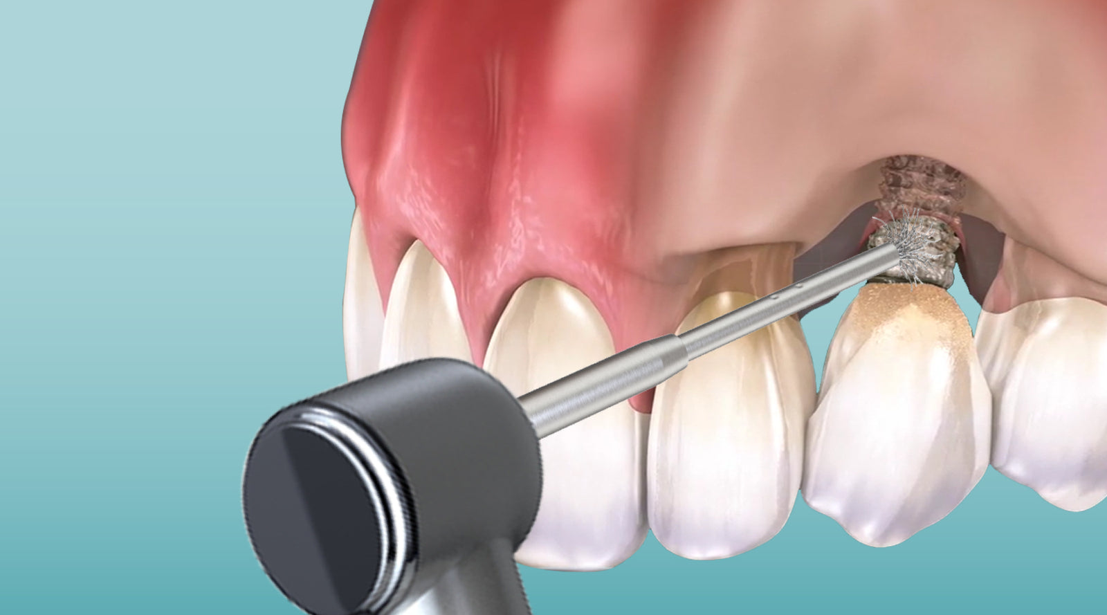 Enhancing Hygiene and Implant Longevity with GDT Dental Implant Cleaning Brushes