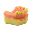  Easyinsmile Upper Jaw Model With Missing Teeth Orthodontic Wax 